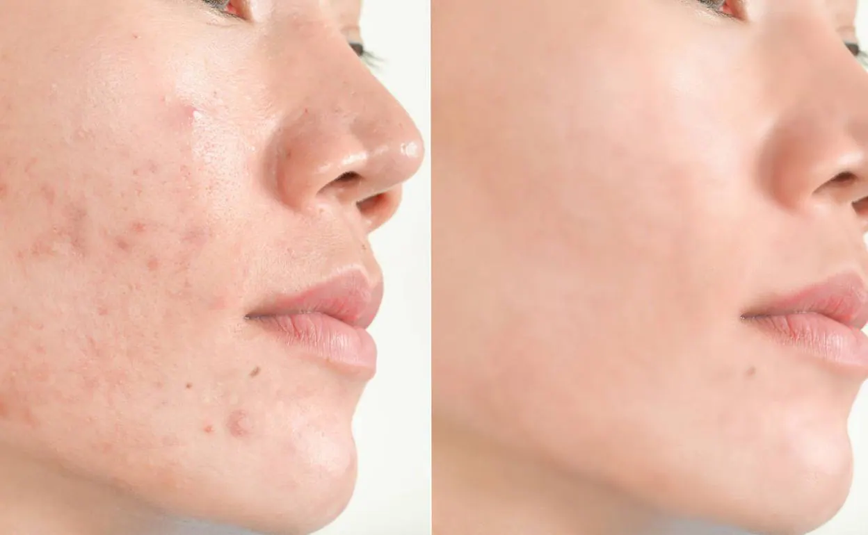 Atención al Acné Después de los 35 años