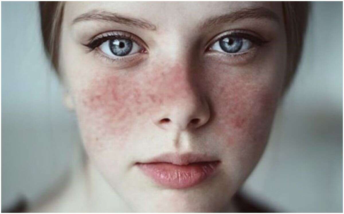 El Día Mundial del Lupus busca crear conciencia sobre esta enfermedad crónica